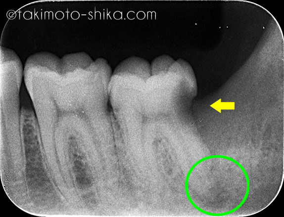 下の一番奥歯の奥にできた深い虫歯の症例 滝本歯科口腔外科クリニックのブログ 滝本歯科口腔外科クリニック