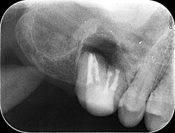 モダンテクニックによる外科的歯内療法