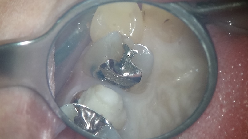 インレーの虫歯