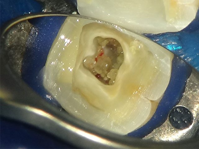 歯髄腔内石灰化物